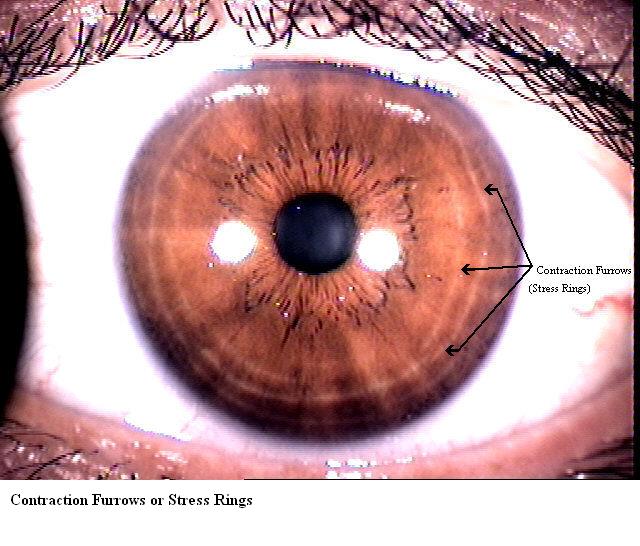 stress
                  rings that iridology says is a result of caffeine.